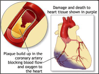 Mesenchymal Stem Cell Therapy in Heart Disease
