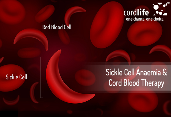 Sickle Cell Anaemia and Cord Blood Therapy