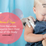 Stories of Hope: Child Receives Transgenic Skin Over Most of His Body