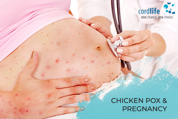 Chicken-Pox-and-Pregnancy