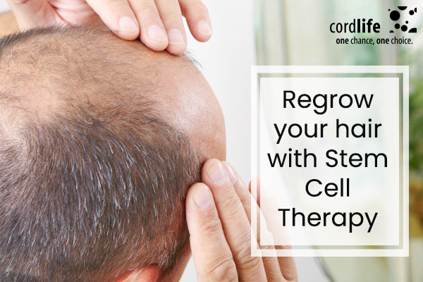 Regrow Your Hair with Stem Cell Therapy - Cordlife India