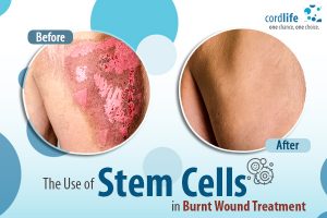 The Use of Stem Cells in Burnt Wound Treatment - Cordlife India