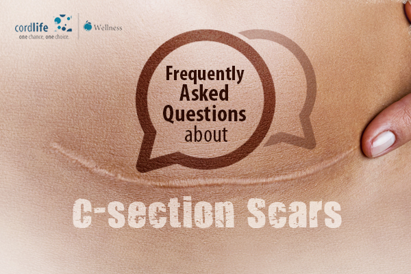 C-section Scars
