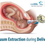 Vacuum Extraction During Delivery