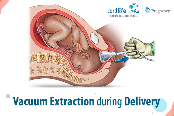 Vacuum Extraction in delivery