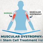 Muscular Dystrophy: Can Stem Cell Treatment Help?