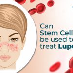 Can Stem Cells Be Used To Treat Lupus?