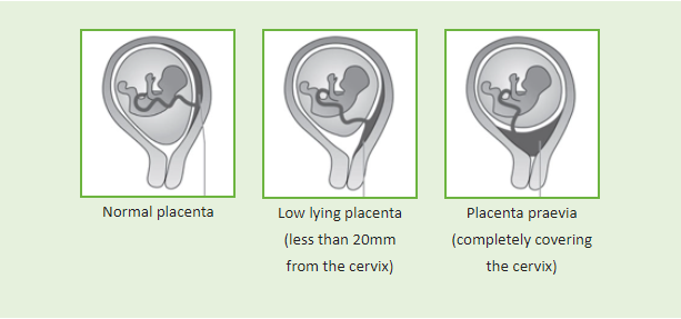 different types of placenta previa during pregnancy