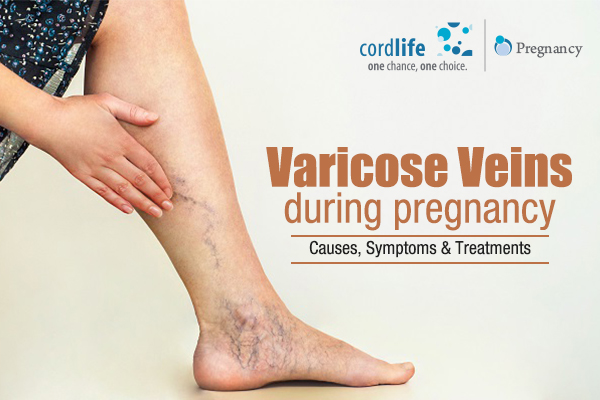 treatment for varicose veins in leg