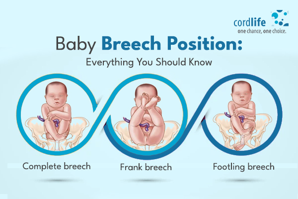 breech baby affect pregnancy