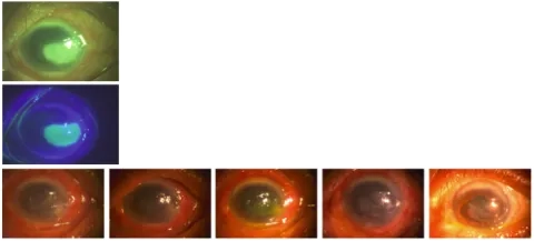 EpSCs and Persistent Epithelial Defect