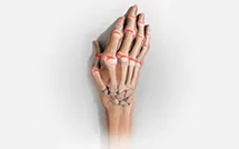 Rheumatoid Arthritis