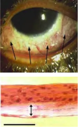 EpSCs and Ocular Surface Disorders