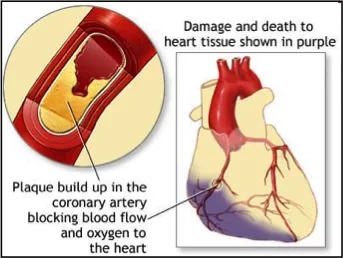 MSCs in Heart Attack